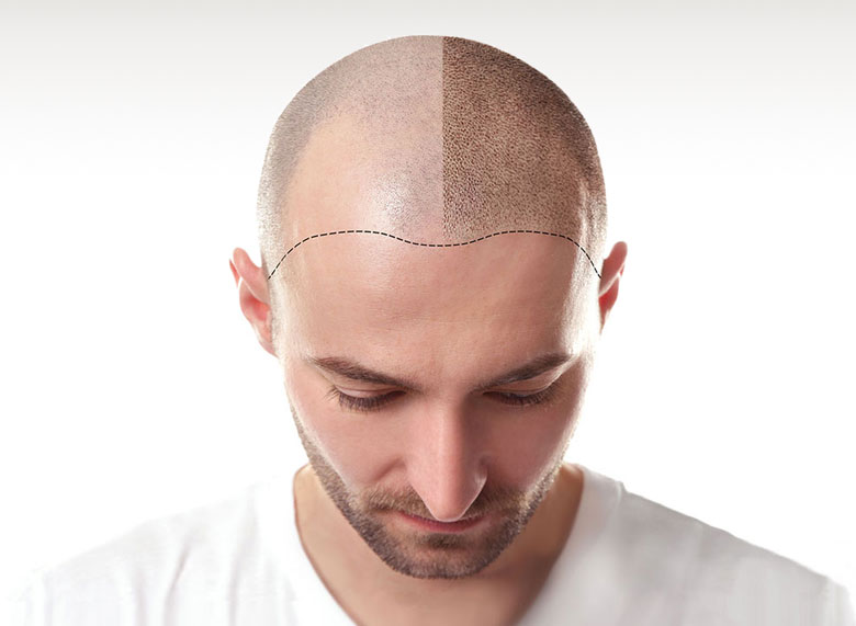 Prettify_Scalp-Micropigmentation_Hamburg PRETTIFY Hamburg Scalp Micropigmentation Kay Elpers