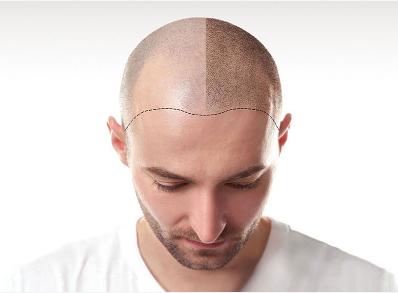 PRETTIFY Hamburg - Scalp Micropigmentation Schulung